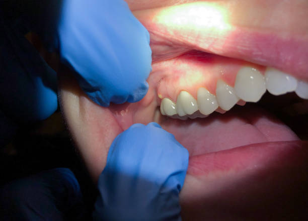 Best Urgent Care for Lost Fillings or Crowns in Colonial Rk, PA